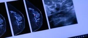 AI Mammogram Tool Predicts Heart Disease Risk in Women, Offers “Two-for-One” Screening